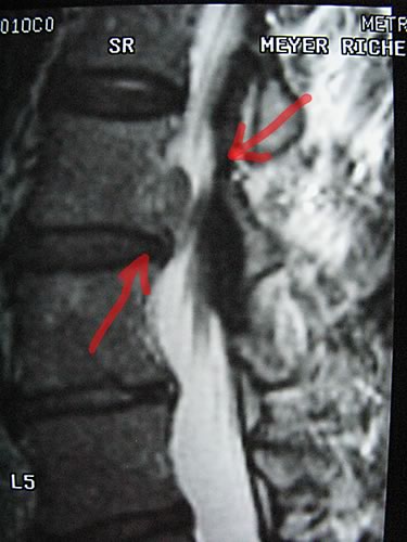 MRI, red arrows indicate broken disc obstructing nerves